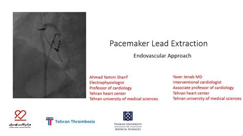 Pacemaker Lead Extraction Endovascular Approach Youtube