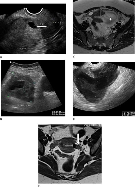 Ectopic Pregnancies In Caesarean Section Scars 5 Years Experience