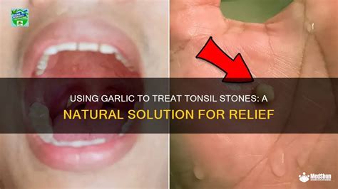 Using Garlic To Treat Tonsil Stones A Natural Solution For Relief