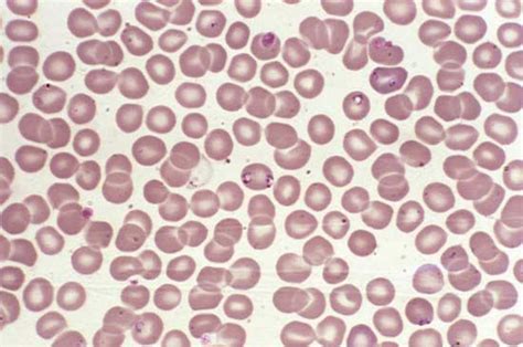 Babesiosis Symptoms Diagnosis Treatment Britannica