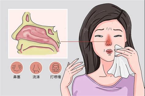 经方常见疾病治症：鼻塞、鼻涕、过敏性鼻炎 知乎