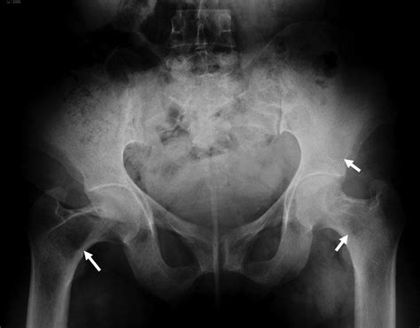 Anteroposterior Plain Radiography Of The Pelvis Shows Multiple