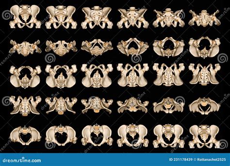 Ct Scan Of Pelvic Bone With Both Hip Joint 3d Rendering Image Inlet