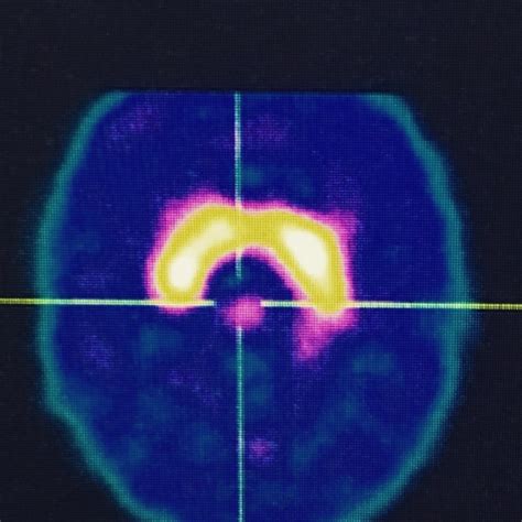 Evaluation Of The [ 99mtc] Trodat 1 Spect In The Diagnosis Of