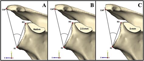 The Critical Acromial Point The Anatomic Location Of The Lateral