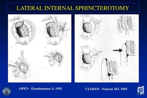 Ppt Treatment Of Anal Fissures Powerpoint Presentation Id 332663