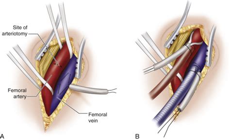 Cannulation Techniques For Cardiopulmonary Bypass Thoracic Key