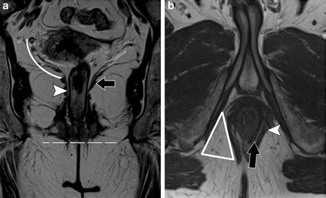 Structured Reporting Of Mri For Perianal Fistula Semantic Scholar