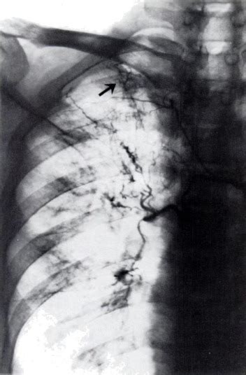 Selective Bronchial Arteriography And Hemoptysis In Nonmalignant Lung