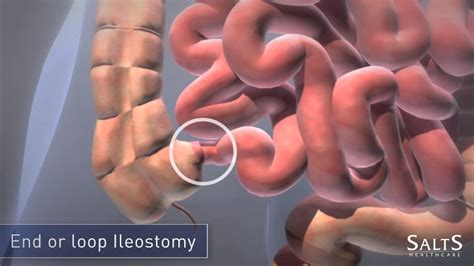 What Is An Ileostomy Youtube