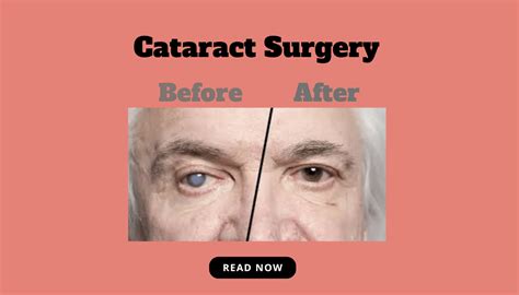 Before And After Cateract Cataract Surgery Tips To Minimise Recovery