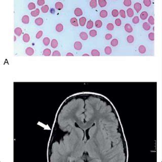 Blood smear and MRI. A) Blood smear of the patient: giant platelets. B ...