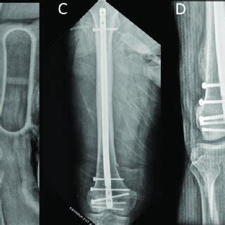 Anteroposterior A And Lateral B Radiographs Of A Year Old Male