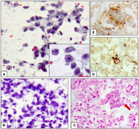 Cytological Features Of Seminoma A Papanicolaou‐stained Smears Of Download Scientific Diagram