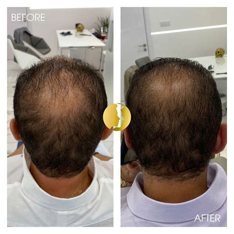 PRP Hair Loss Treatment - Bellissimo Clinic