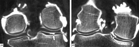 commonest locations  chondral lesions   knee   arthro ct