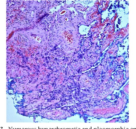 Figure 3 From An Unusual Presentation Of Stewart Treves Syndrome On The