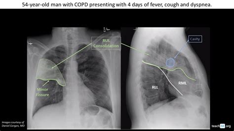 Bacterial Pneumonia with Abscess | CXR | teachIM