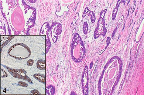 Intraductal Urothelial Carcinoma That May Mimic Intraductal Carcinoma