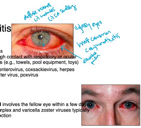 Conjunctiva Infections Flashcards Quizlet