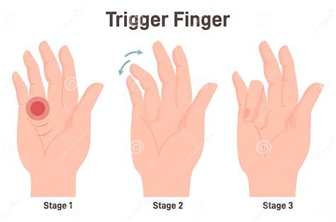 Trigger Finger Or Finger Lock Disease Causing Pain Stiffness And A