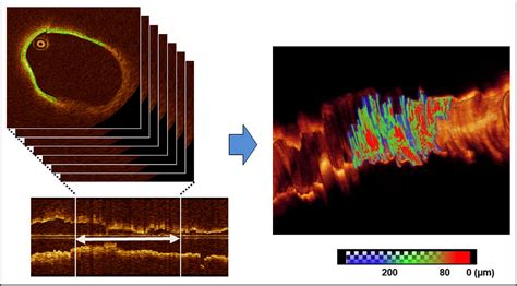 Figure From Optical Coherence Tomography Predictors For A Favorable