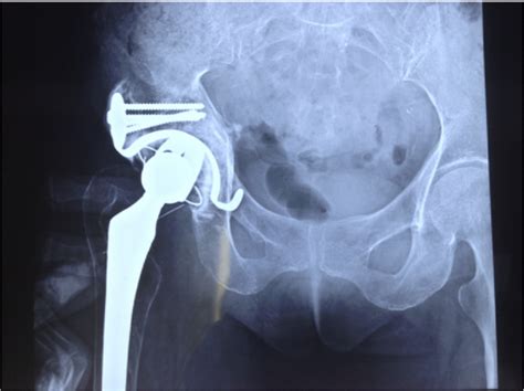 Figure From Iliopsoas Impingement After Revision Total Hip