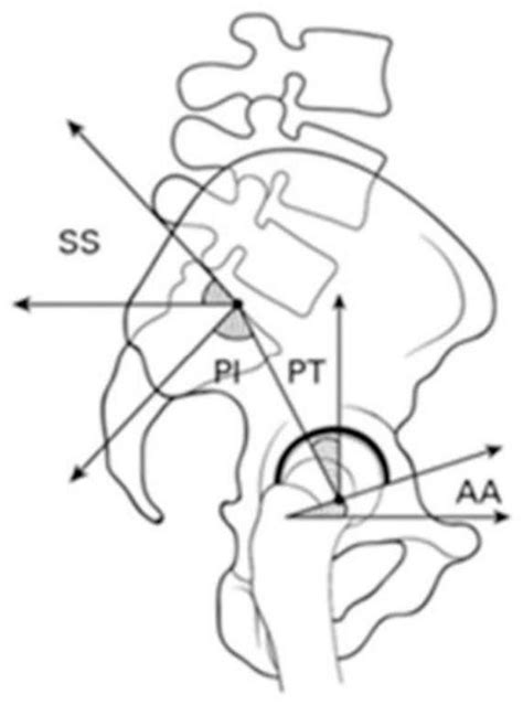 System And Method For Preoperative Planning For Total Hip Arthroplasty