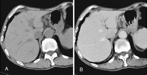 Figure 1 From A Case Of Hepatic Sclerosed Hemangioma Recognized As A