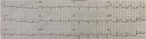 Dr Smith S Ecg Blog Ventricular Fibrillation Resuscitation And