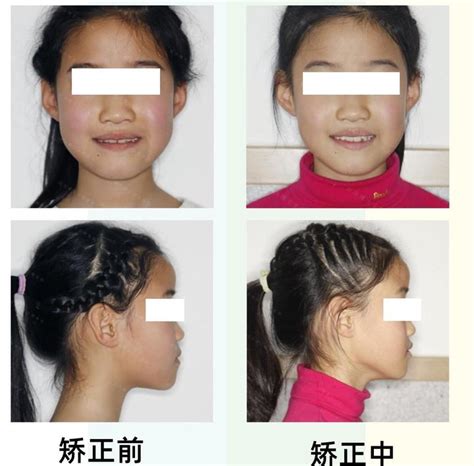 重庆牙齿矫正正畸【整牙案例分享】——牙缝儿过宽怎么办？ 知乎