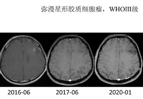 一文读懂脑胶质瘤早期症状、治疗及预后胶质瘤治疗肿瘤 健康界