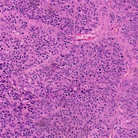 Histopathology Of The Ovaries Malignant Brenner Tumors Show