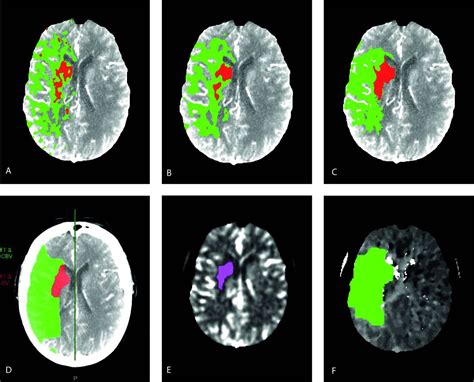 Comparison Of Three Commonly Used Ct Perfusion Software Packages In