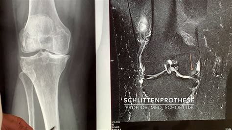 Teilprothese Am Knie Schlittenprothese Prof Dr Med Philip