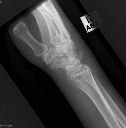 Triquetral fracture | Radiology Reference Article | Radiopaedia.org