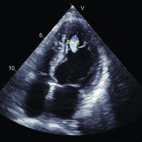 Preoperative Transthoracic Echocardiography Image Preoperative