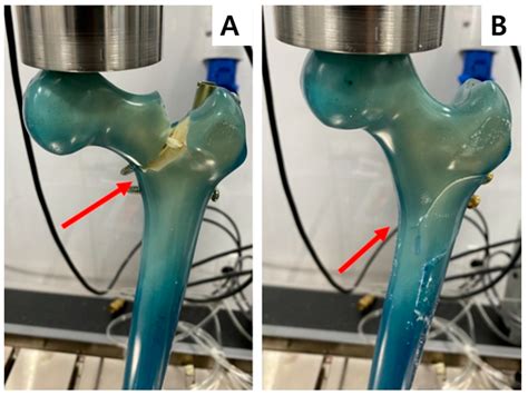 JCM Free Full Text Prophylactic Femoral Neck Fixation In An