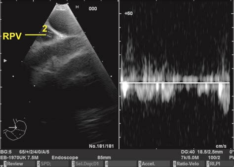 Techniques Of Linear Endobronchial Ultrasound Intechopen