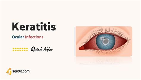 Ocular Infections Keratitis