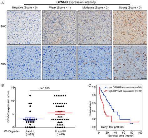 Prognostic Role Of GPNMB In Glioma Confirmed In Tissue Microarrays A