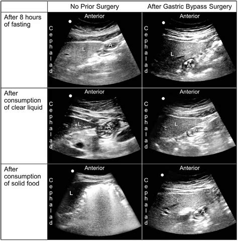 Figure 1 from Ultrasound Assessment of Gastric Volume After Bariatric ...