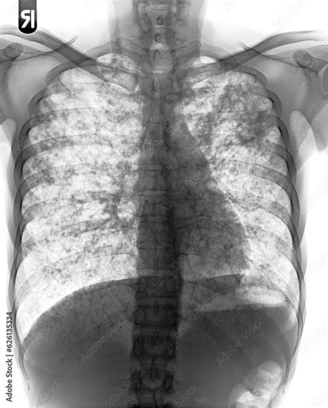 Pulmonary Tuberculosis Film Chest X Ray Interstitial Infiltrate Both Lung ภาพถ่ายสต็อก