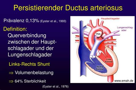 Ppt Persistierender Ductus Arteriosus Pda Und Der Pon Im Speziellen