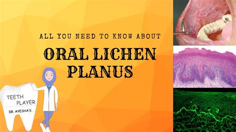 Oral Lichen Planus Clinical Presentationtypes Diagnosis Treatment