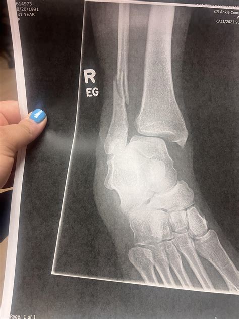 Fractured fibula : r/XRayPorn