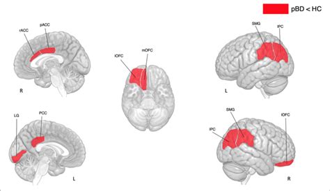 Differences In Cortical Thickness Between Subjects With Pbd And Hc