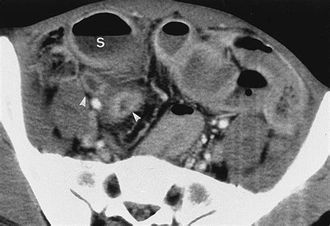 Ct Evaluation Of Small Bowel Obstruction Radiographics