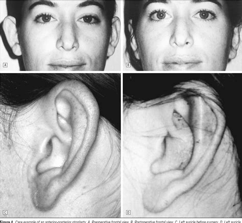 Figure From The Anterior Posterior Otoplasty Semantic Scholar