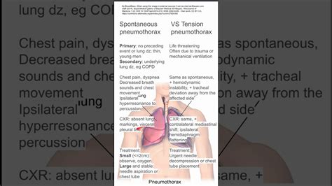 Spontaneous Vs Tension Pneumothorax